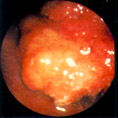 Аденомы желудочно-кишечного тракта (аденоматозные полипы)